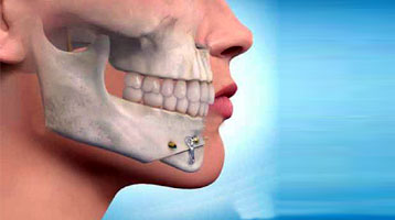 Maxillofacial Surgery